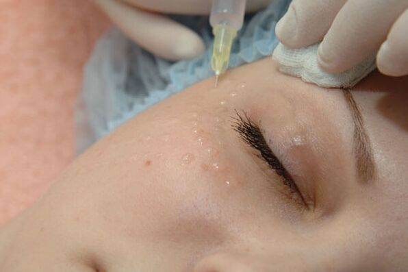 Mesoterapia un metodo di iniezione per il ringiovanimento della pelle del viso