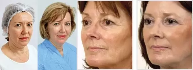 Il risultato del ringiovanimento della pelle del viso con il laser è la riduzione delle rughe