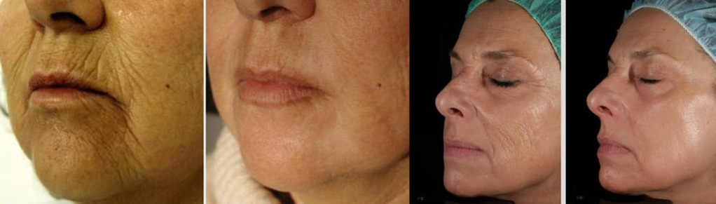Pelle del viso prima e dopo la procedura di ringiovanimento laser
