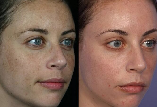 Trattamento in pelle laser