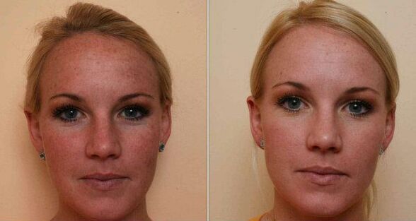 prima e dopo il ringiovanimento della pelle del viso con il laser