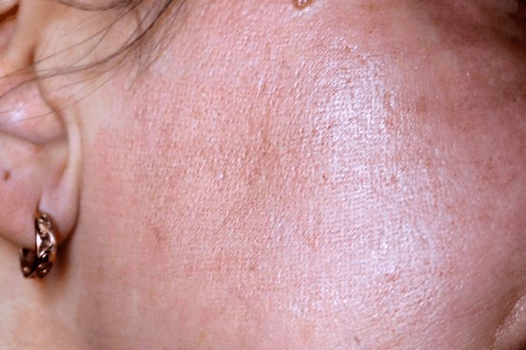 arrossamento della pelle dopo il ringiovanimento laser