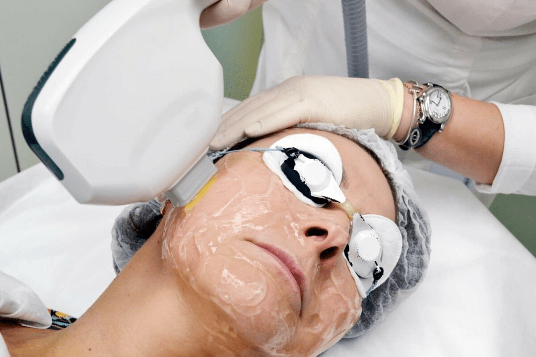 ringiovanimento laser per la pelle del viso